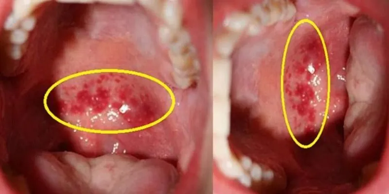 Các triệu chứng viêm họng mãn tính