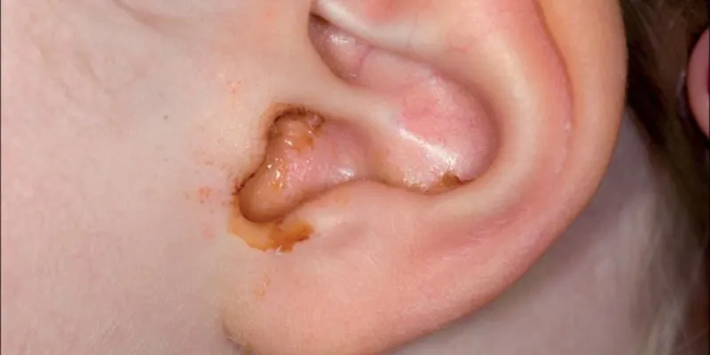 xử lý khi trẻ bị đau tai