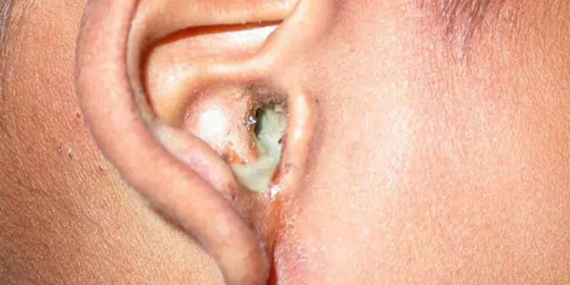 Trẻ bị liệt mặt, da bọc xương