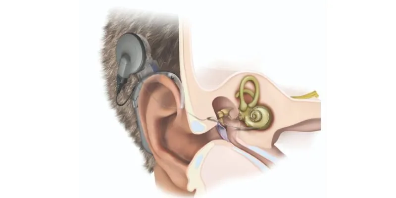 Cấy Ốc Tai Điện Tử Chữa Điếc