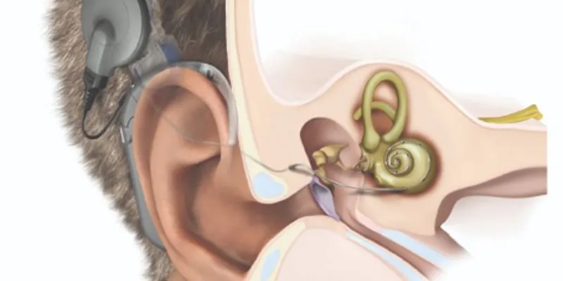 hành trình cấy ốc tai điện tử