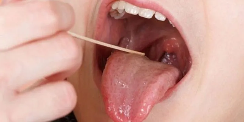 Ung thư Vòm họng