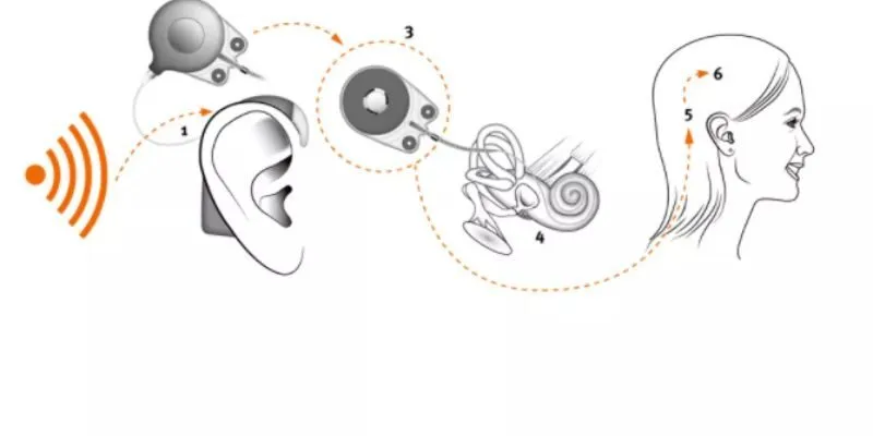 Chỉ định Cấy ốc tai điện tử