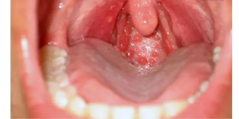 bệnh lý về họng