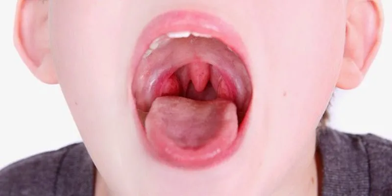 thói đỏng đảnh của amidan