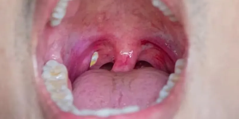 thói đỏng đảnh của amidan