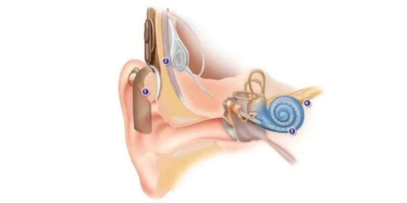 Chi phí cấy ốc tai điện tử hiện nay