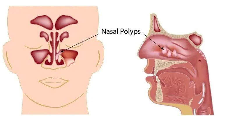 Bệnh polyp mũi