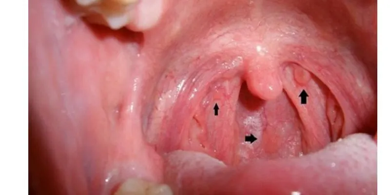 bệnh lý về họng