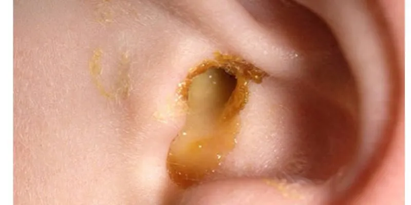 những vấn đề về tai thường gặp