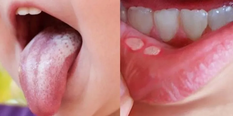 triệu chứng bệnh viêm amidan ở trẻ