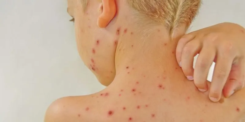 nguyên nhân gây viêm xoang ở trẻ em