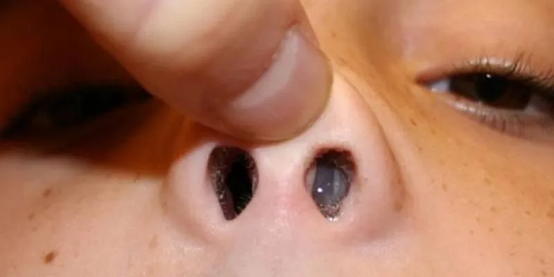 Nguyên nhân gây ngạt mũi ở trẻ